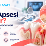 Diş eti üzerinde oluşan apse ve çevresindeki iltihabı gösteren illüstrasyon — Dentasay Mardin diş apsesi belirtileri, nedenleri ve tedavisi görseli.