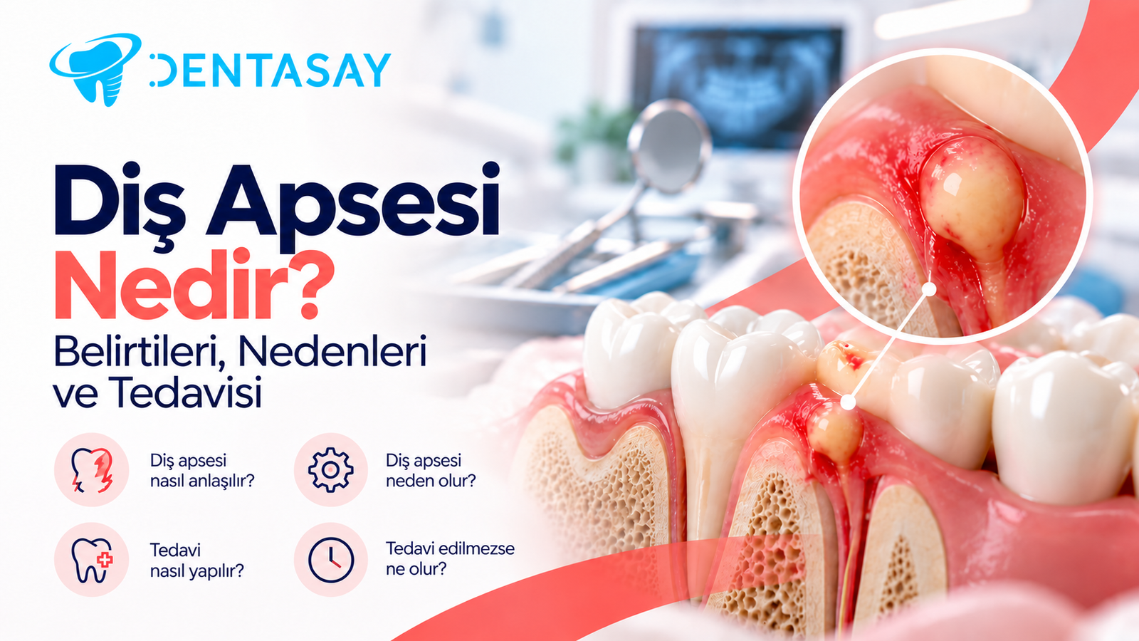 Diş eti üzerinde oluşan apse ve çevresindeki iltihabı gösteren illüstrasyon — Dentasay Mardin diş apsesi belirtileri, nedenleri ve tedavisi görseli.