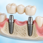 İki dental implant üzerine yerleştirilen üç dişli köprü protezinin temsili görünümü.